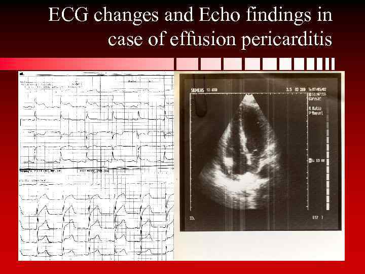 ECG changes and Echo findings in case of effusion pericarditis 