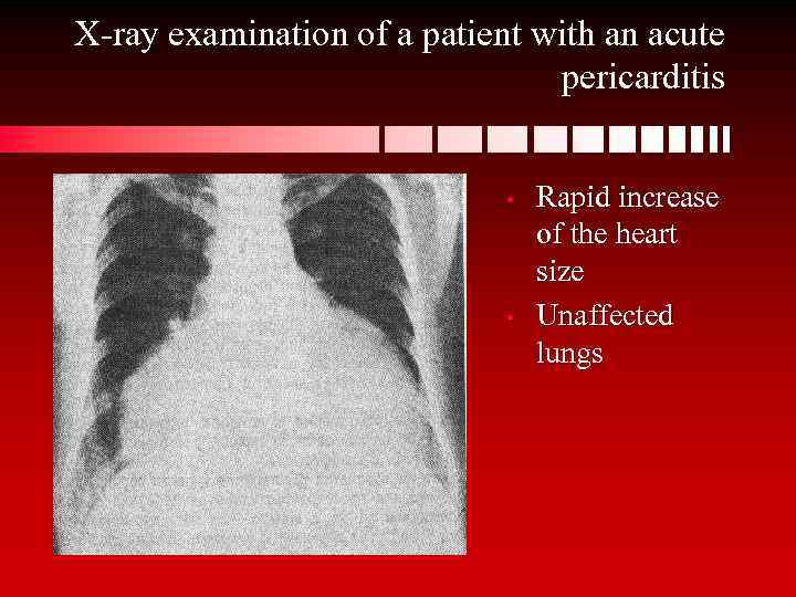X-ray examination of a patient with an acute pericarditis • • Rapid increase of