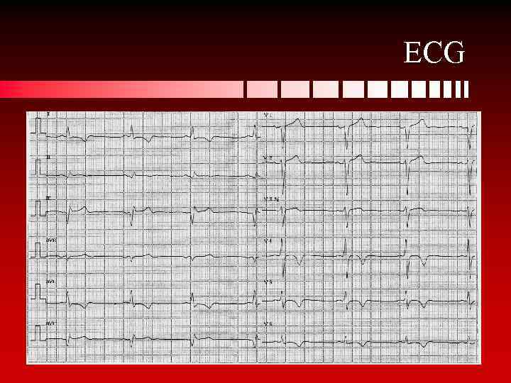 ECG 