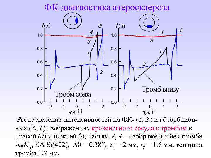 ФК-диагностика атеросклероза Распределение интенсивностей на ФК- (1, 2 ) и абсорбционных (3, 4 )