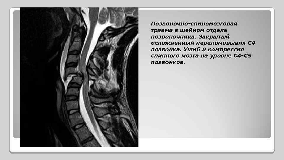 Позвоночно-спиномозговая травма в шейном отделе позвоночника. Закрытый осложненный переломовывих С 4 позвонка. Ушиб и
