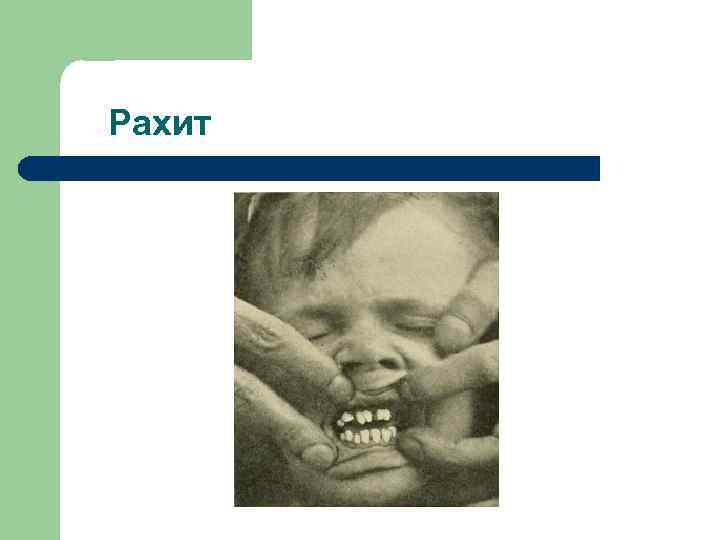 Рахит 