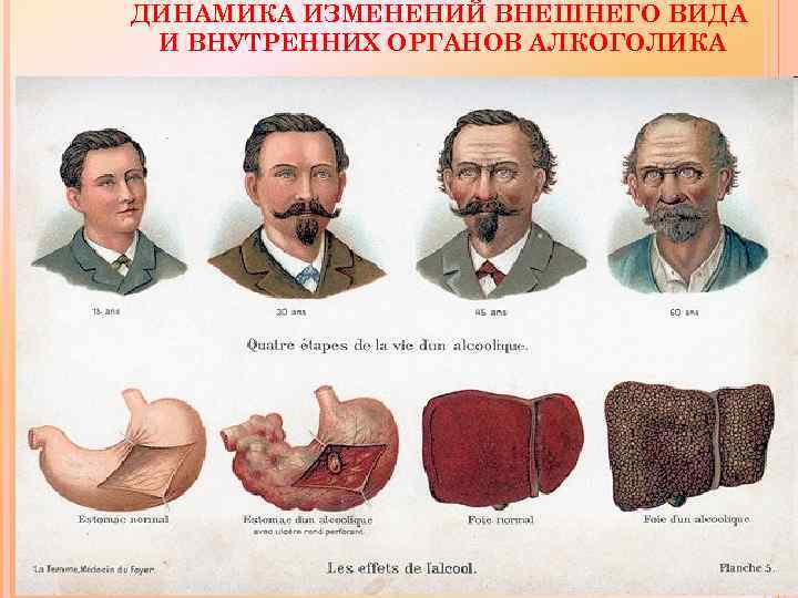 ДИНАМИКА ИЗМЕНЕНИЙ ВНЕШНЕГО ВИДА И ВНУТРЕННИХ ОРГАНОВ АЛКОГОЛИКА 