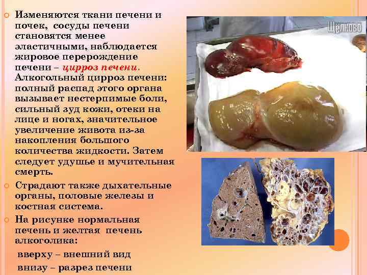  Изменяются ткани печени и почек, сосуды печени становятся менее эластичными, наблюдается жировое перерождение