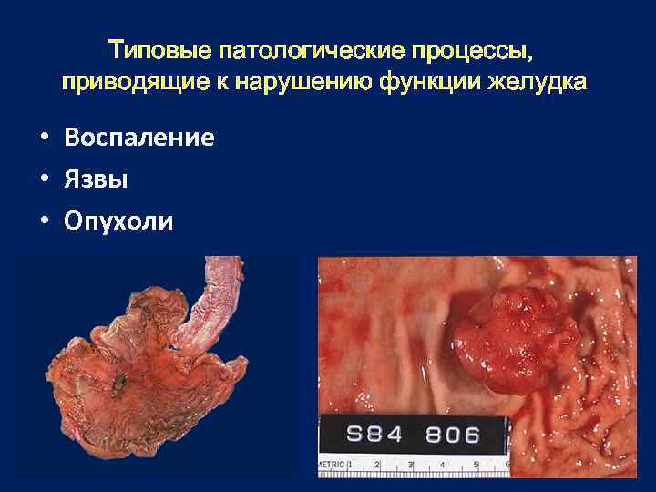 Типовые патологические процессы, приводящие к нарушению функции желудка • Воспаление • Язвы • Опухоли