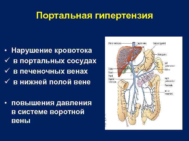 Портальная гипертензия • Нарушение кровотока ü в портальных сосудах ü в печеночных венах ü