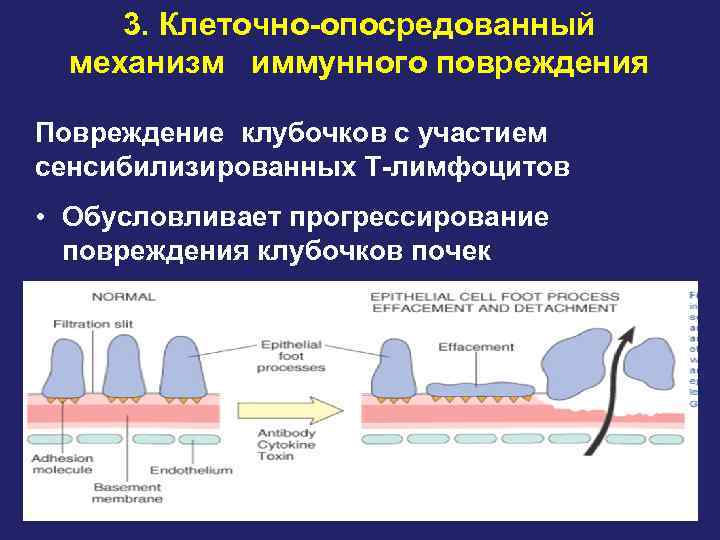 3. Клеточно-опосредованный механизм иммунного повреждения Повреждение клубочков с участием сенсибилизированных Т-лимфоцитов • Обусловливает прогрессирование