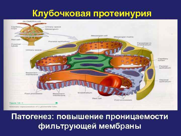 Клубочковая протеинурия Патогенез: повышение проницаемости фильтрующей мембраны 