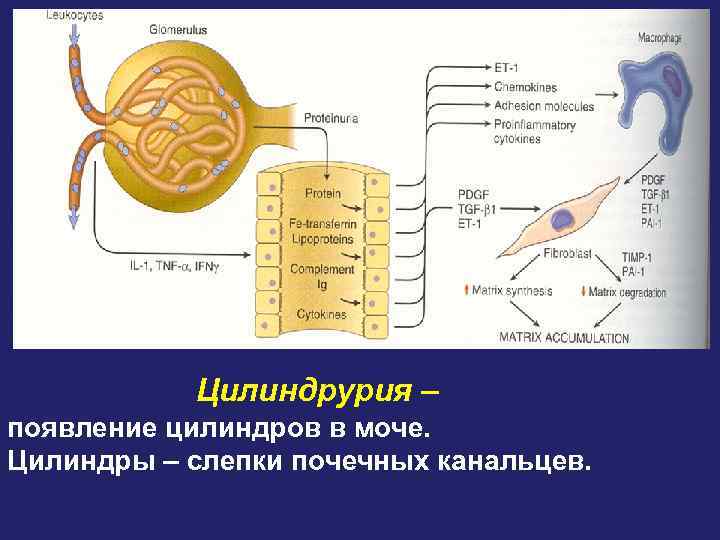 Цилиндрурия – появление цилиндров в моче. Цилиндры – слепки почечных канальцев. 