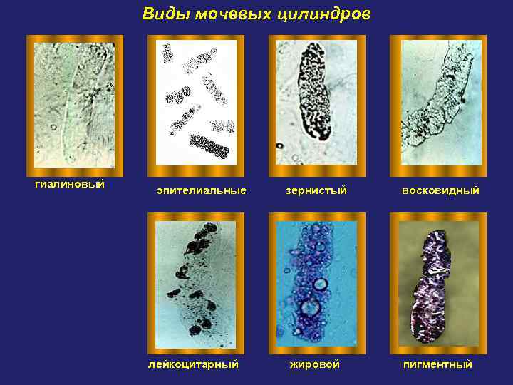 Виды мочевых цилиндров гиалиновый эпителиальные лейкоцитарный зернистый восковидный жировой пигментный 