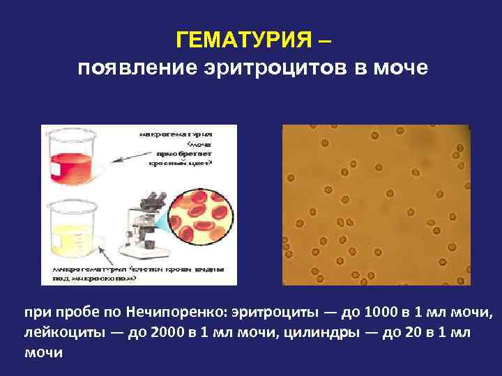 ГЕМАТУРИЯ – появление эритроцитов в моче при пробе по Нечипоренко: эритроциты — до 1000