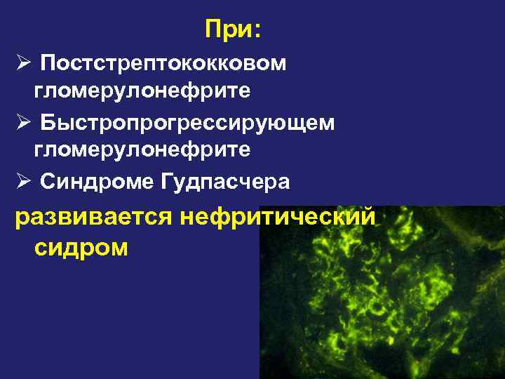 При: Ø Постстрептококковом гломерулонефрите Ø Быстропрогрессирующем гломерулонефрите Ø Синдроме Гудпасчера развивается нефритический сидром 