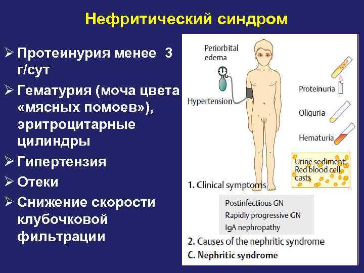 Нефритический синдром Ø Протеинурия менее 3 г/сут Ø Гематурия (моча цвета «мясных помоев» ),