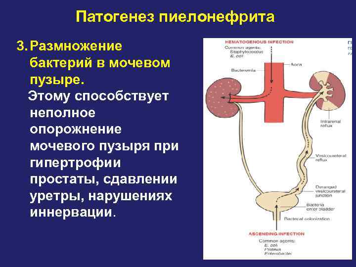 Схема патогенеза пиелонефрита