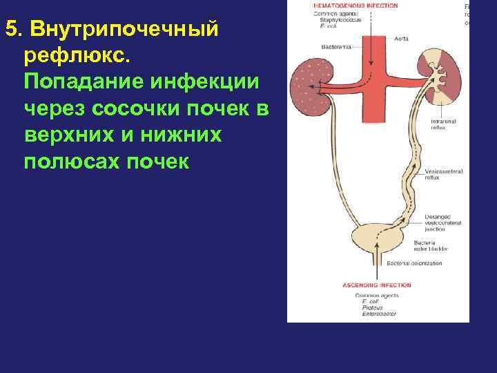 5. Внутрипочечный рефлюкс. Попадание инфекции через сосочки почек в верхних и нижних полюсах почек