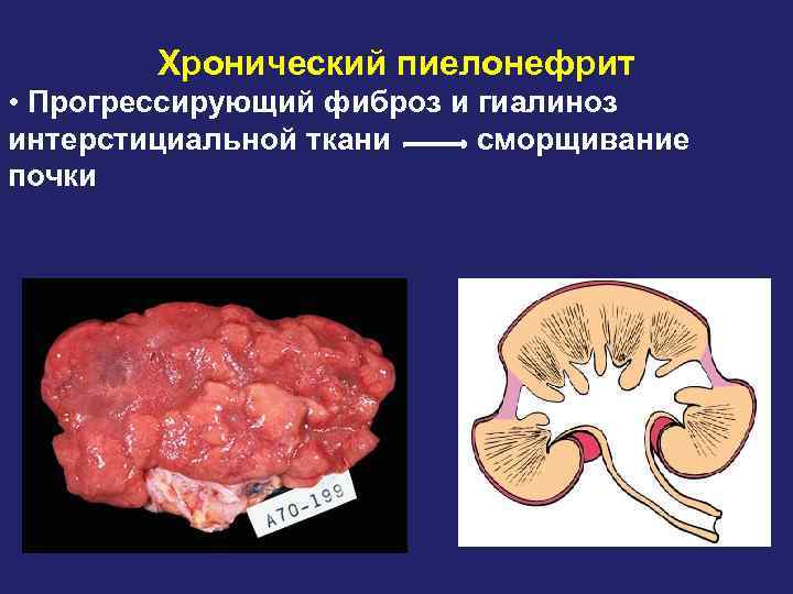 Хронический пиелонефрит • Прогрессирующий фиброз и гиалиноз интерстициальной ткани сморщивание почки 