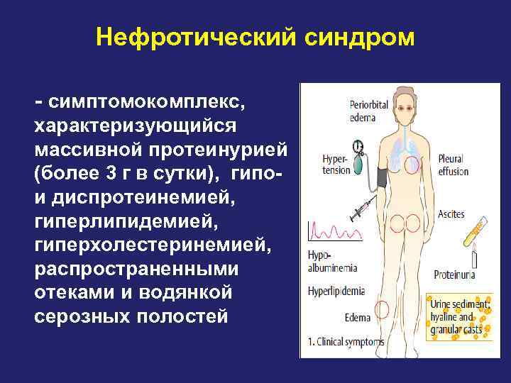 Нефротический синдром - симптомокомплекс, характеризующийся массивной протеинурией (более 3 г в сутки), гипо- и