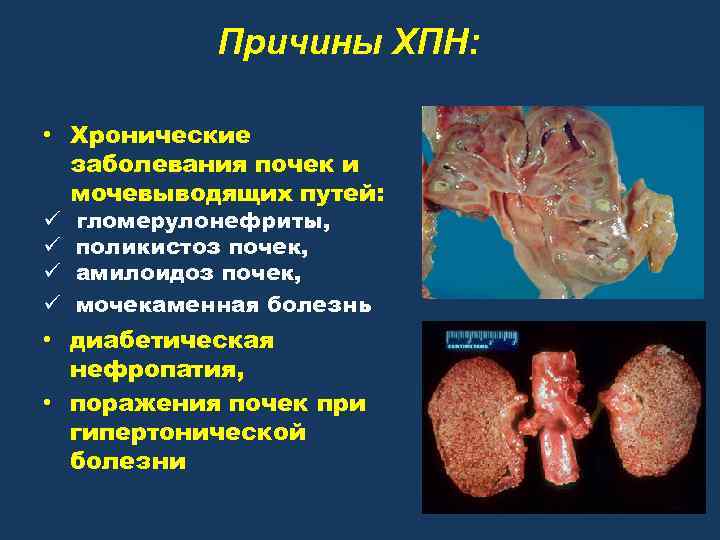 Причины ХПН: • Хронические заболевания почек и мочевыводящих путей: ü ü гломерулонефриты, поликистоз почек,