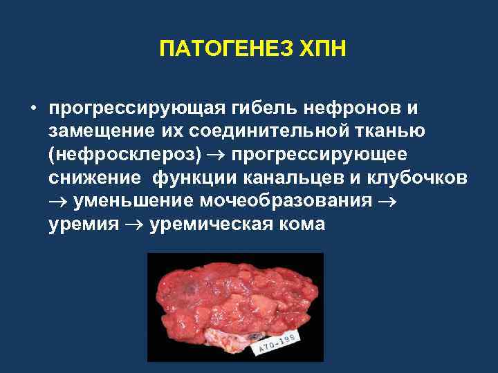 ПАТОГЕНЕЗ ХПН • прогрессирующая гибель нефронов и замещение их соединительной тканью (нефросклероз) прогрессирующее снижение