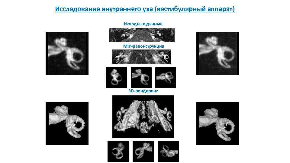 Исследование внутреннего уха (вестибулярный аппарат) Исходные данные MIP-реконструкция 3 D-рендеринг 