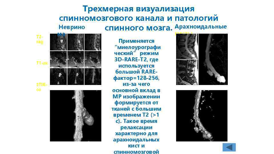 Трехмерная визуализация спинномозгового канала и патологий Неврино спинного мозга. Арахноидальные T 2 sag T