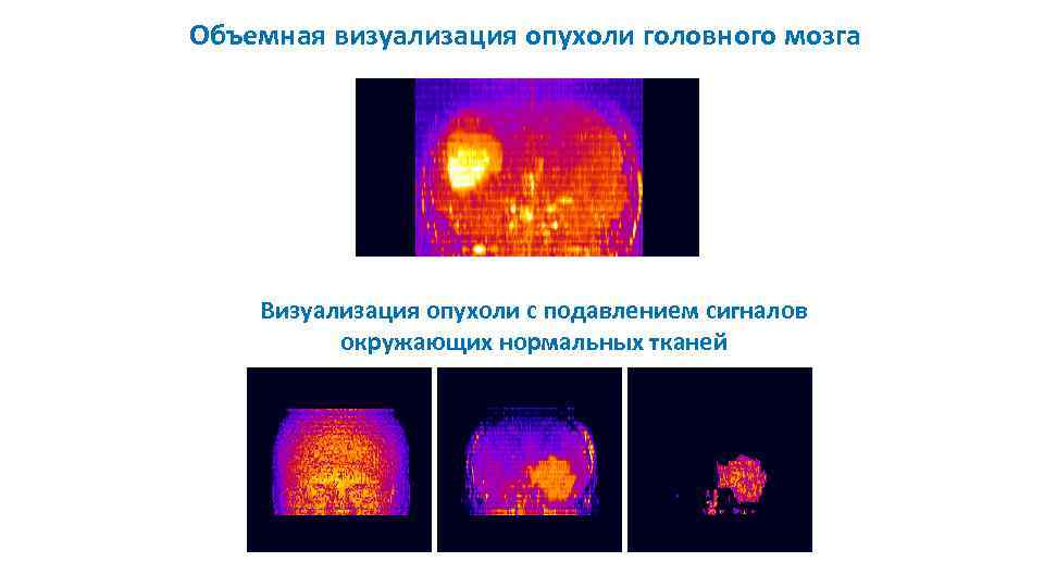 Объемная визуализация опухоли головного мозга Визуализация опухоли с подавлением сигналов окружающих нормальных тканей 