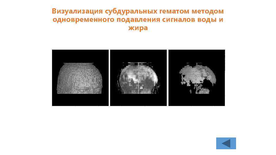 Визуализация субдуральных гематом методом одновременного подавления сигналов воды и жира 