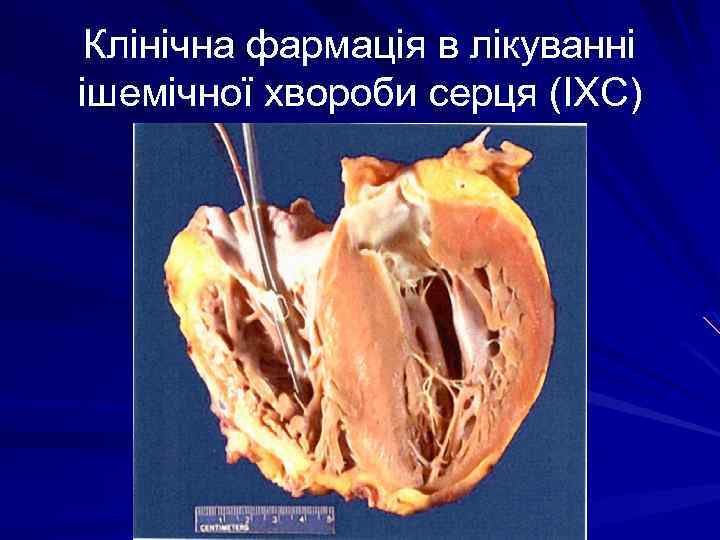 Клінічна фармація в лікуванні ішемічної хвороби серця (ІХС) 