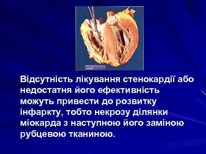Відсутність лікування стенокардії або недостатня його ефективність можуть привести до розвитку інфаркту, тобто некрозу