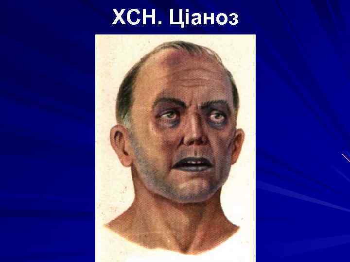 ХСН. Ціаноз 