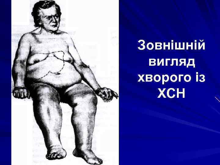 Зовнішній вигляд хворого із ХСН 