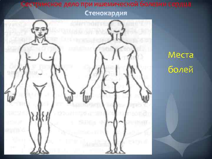 Сестринское дело при ишемической болезни сердца Карта оценки боли Места болей 