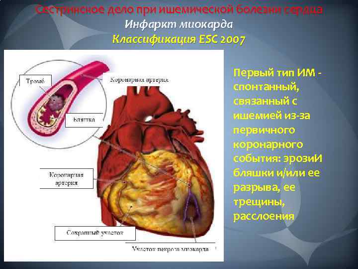 Сестринское дело при ишемической болезни сердца Инфаркт миокарда Классификация ESC 2007 Карта оценки боли