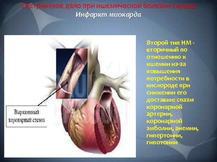 Сестринское дело при ишемической болезни сердца Инфаркт миокарда Карта оценки боли Второй тип ИМ