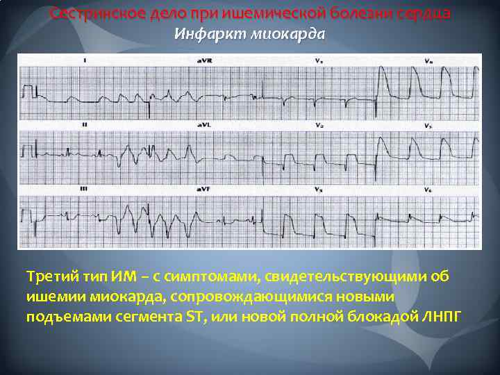 Сестринское дело при ишемической болезни сердца Инфаркт миокарда Карта оценки боли Третий тип ИМ