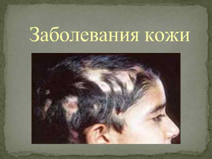 Заболевания кожи 