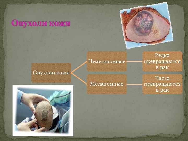 Опухоли кожи Немеланомные Редко превращаются в рак Меланомные Часто превращаются в рак Опухоли кожи