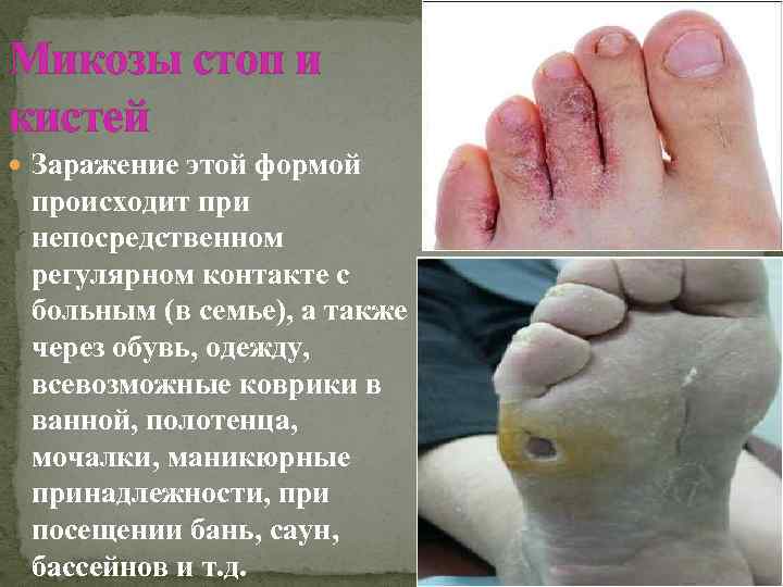 Микозы стоп и кистей Заражение этой формой происходит при непосредственном регулярном контакте с больным