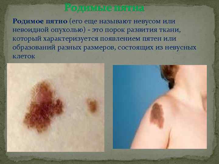 Родимые пятна Родимое пятно (его еще называют невусом или невоидной опухолью) - это порок
