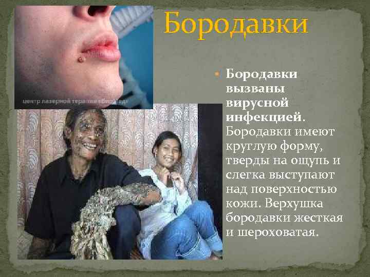 Бородавки • Бородавки вызваны вирусной инфекцией. Бородавки имеют круглую форму, тверды на ощупь и