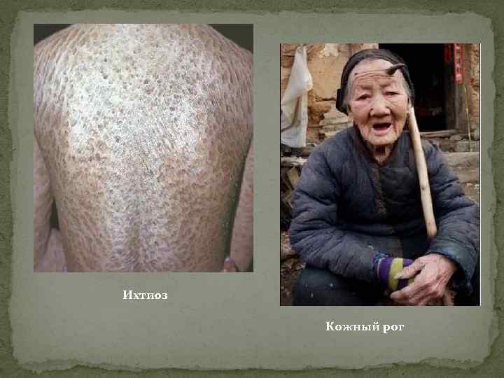 Ихтиоз Кожный рог 