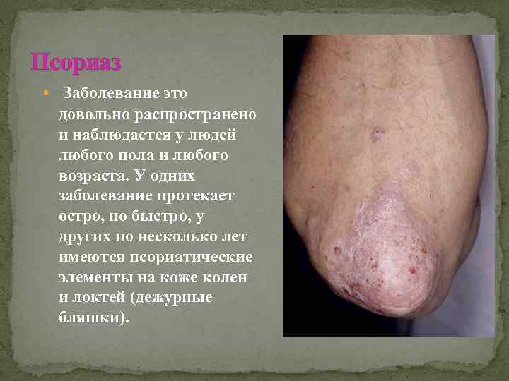 Псориаз • Заболевание это довольно распространено и наблюдается у людей любого пола и любого