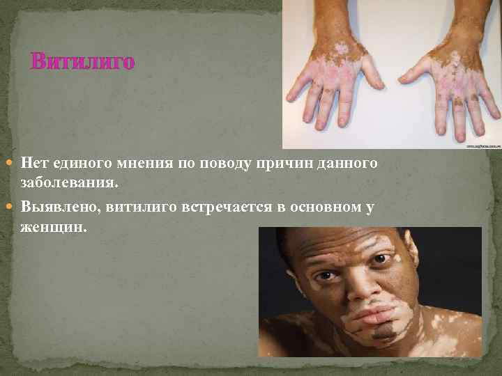 Витилиго Нет единого мнения по поводу причин данного заболевания. Выявлено, витилиго встречается в основном