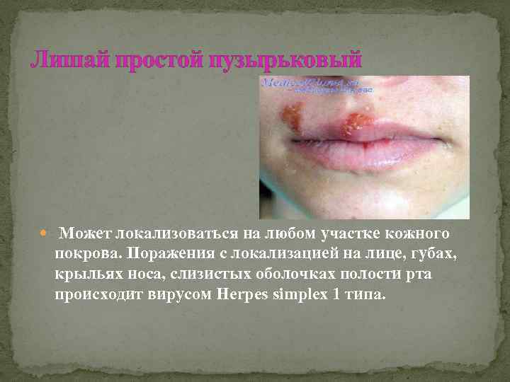 Лишай простой пузырьковый Может локализоваться на любом участке кожного покрова. Поражения с локализацией на