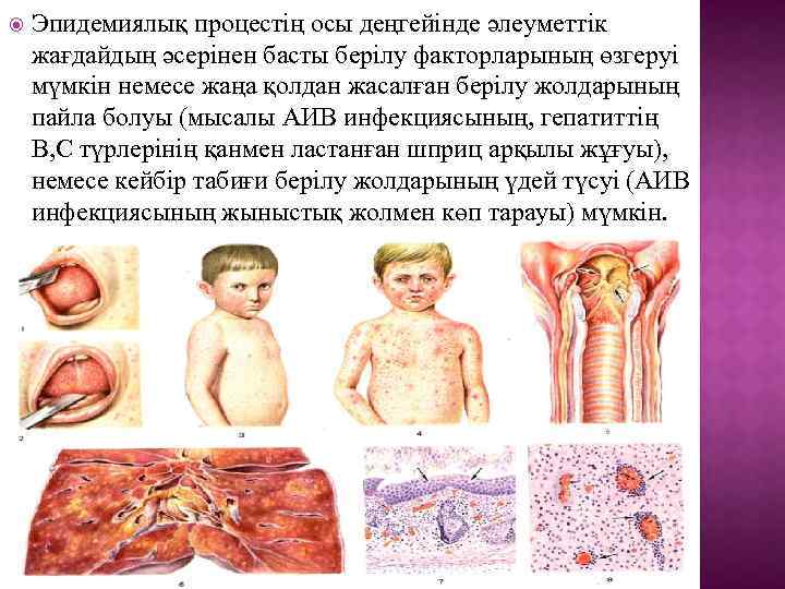  Эпидемиялық процестің осы деңгейінде әлеуметтік жағдайдың әсерінен басты берілу факторларының өзгеруі мүмкін немесе
