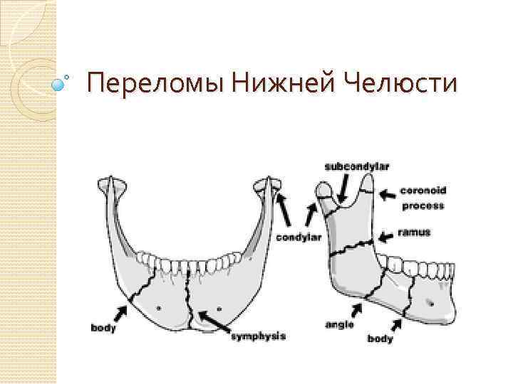 Перелом нижней челюсти карта вызова