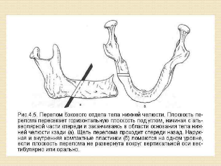 Перелом нижней челюсти карта вызова