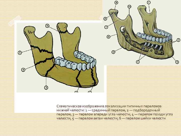 Схематическое изображение локализации типичных переломов нижней челюсти: 1 — срединный перелом; 2 — подбородочный