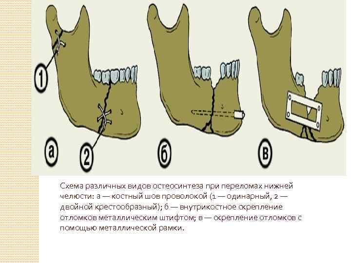 Схема различных видов остеосинтеза при переломах нижней челюсти: а — костный шов проволокой (1