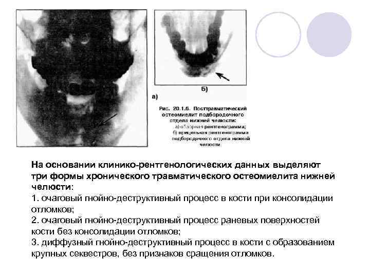 На основании клинико-рентгенологических данных выделяют три формы хронического травматического остеомиелита нижней челюсти: 1. очаговый